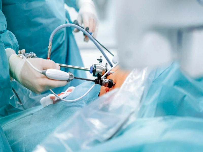 جراحی چاقی مسیر سریع و مطمئن برای لاغری