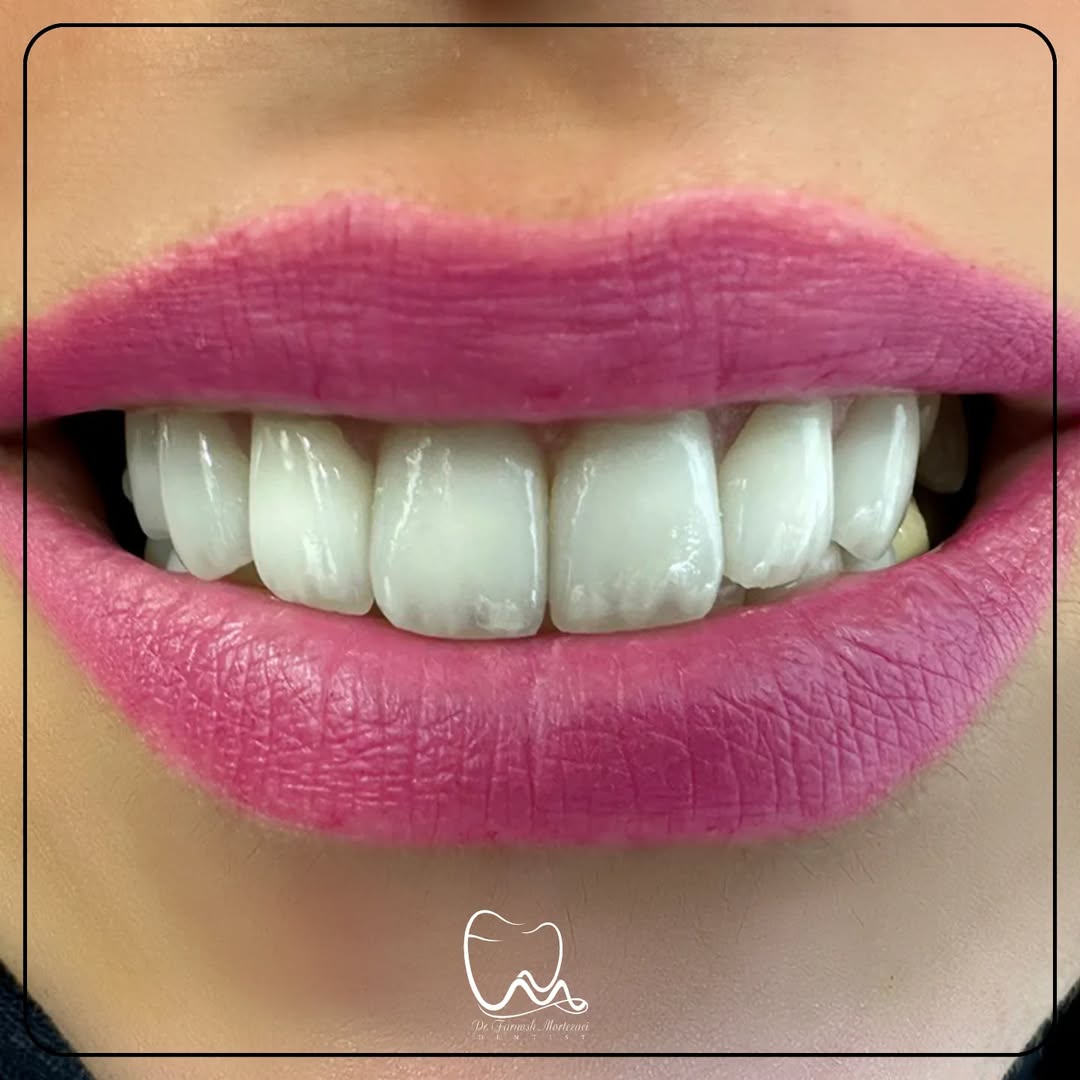 نمونه خدمات دندانپزشکی کودکان در کلینیک دکتر فرنوش مرتضایی؛ دندانپزشکی طرف قرارداد با بیمه کوثر در تهران