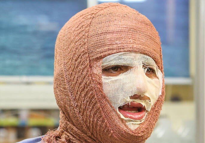 «جان نو» به کمک بیماران سوختگی میآید
